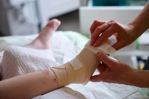 03 April 2024, Saxony, Zwickau: K?the, who suffers from the very rare butterfly disease, undergoes daily, two-hour dressing changes. The four-year-old suffers from incurable epidermolysis bullosa (EB) - a genetic defect causes the cohesion of the skin layers to be weakened. The result: even the smallest injuries, friction or pressure lead to blisters and open wounds. A new treatment method from the USA offers hope. A gel is used to supply the skin with new collagen7A1 genes. The sticking point: the price of around 800,000 US dollars (around 737,000 euros) for a six-month treatment. Photo: Jan Woitas/dpa Photo: Jan Woitas/DPA