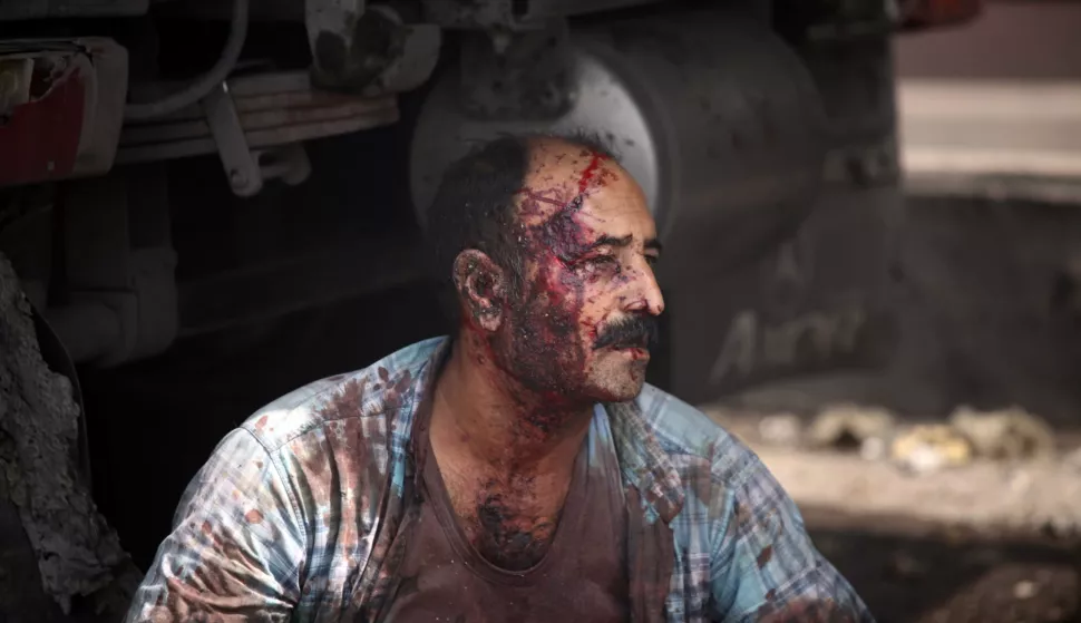 epa12056412 GRAPHIC CONTENT - An injured worker rests near the site of an explosion at the Rajaie port in the city of Bandar Abbas, southern Iran, 26 April 2025. Iranian state media reported on 26 April several injuries in an explosion at the port, but authorities have not yet announced the cause. EPA/Mohammad Rasoul Moradi -- ATTENTION EDITORS: GRAPHIC CONTENT --