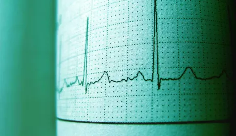 EKG srca