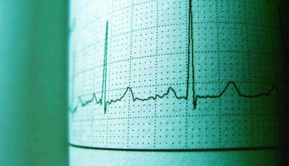 EKG srca
