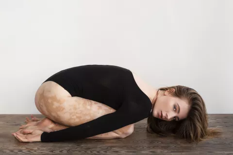 Destigmatizacija: Biološke terapije liječe i do 90 posto promjena koje nosi vitiligo