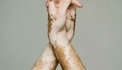 BOLEST VITILIGO
