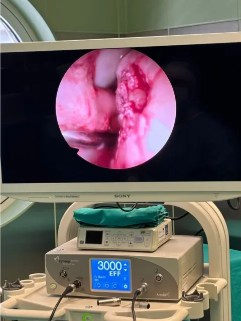 Opća županijska bolnica Vinkovci, Operacija koljena, Autocart metoda, hrskavica