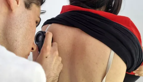 POŽEGA - U subotu je u Požegi 95 građana pristupilo besplatnom dermatološkom pregledu u sklopu dm-ove inicijative "Zaštiti se... i uživaj na suncu", čiji je cilj educirati što veći broj ljudi o zaštiti od UV zračenja i potaknuti na preventivne preglede. Mislav Mokos, dr. med., i Gorana Dokuzović, dr. med., pregledavali su madeže i promjene na koži te su 7 građana uputili na daljnje pretrage. D.S.R.svibanj 2025.madež