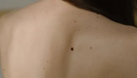 Besplatni pregledi madeža uz prijave u Na&scaron;icama, Valpovu i Osijeku