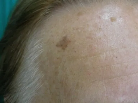 Koliko je melanom čest i za&scaron;to je prevencija ključna